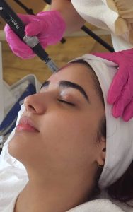 Microneedling
