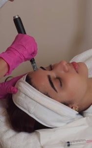 Microneedling