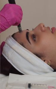Microneedling